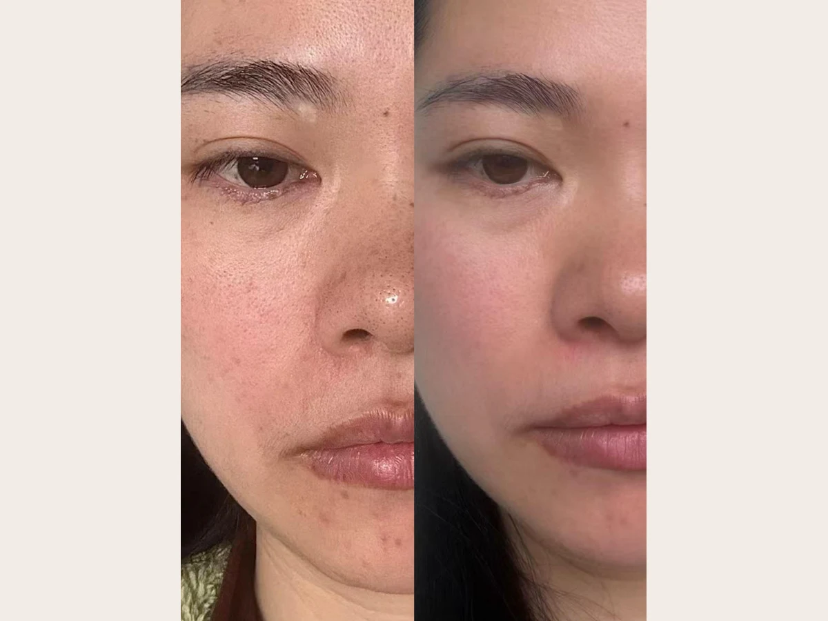 Peko 客人療程前後對比(同一客人、同一部位,已獲同意)
