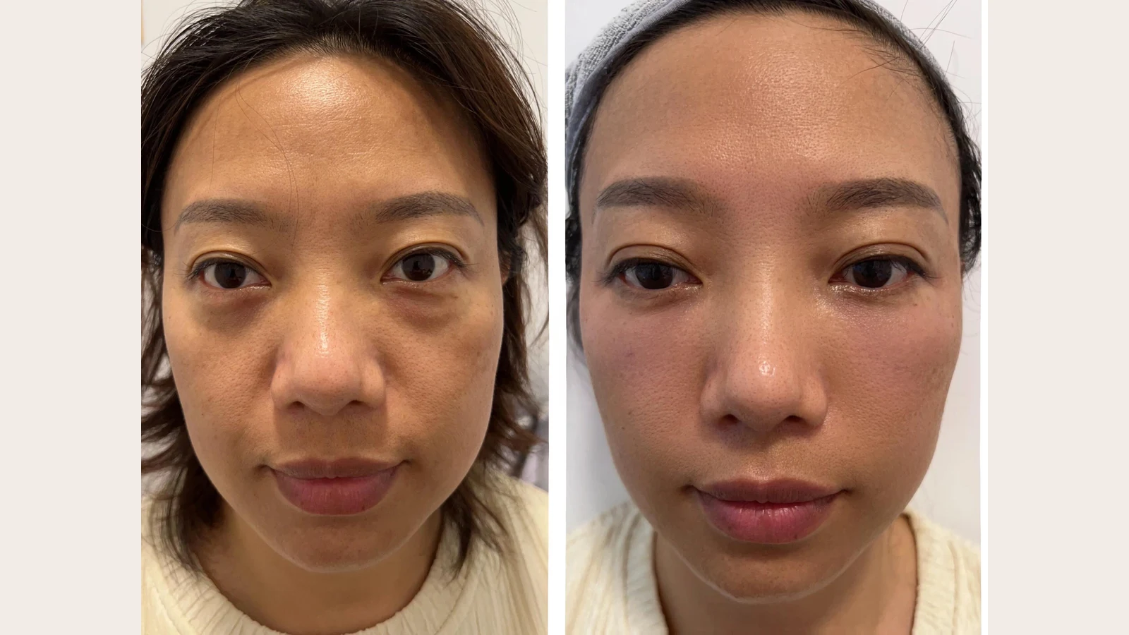 Peko 客人療程前後對比(真實個案,已獲同意)