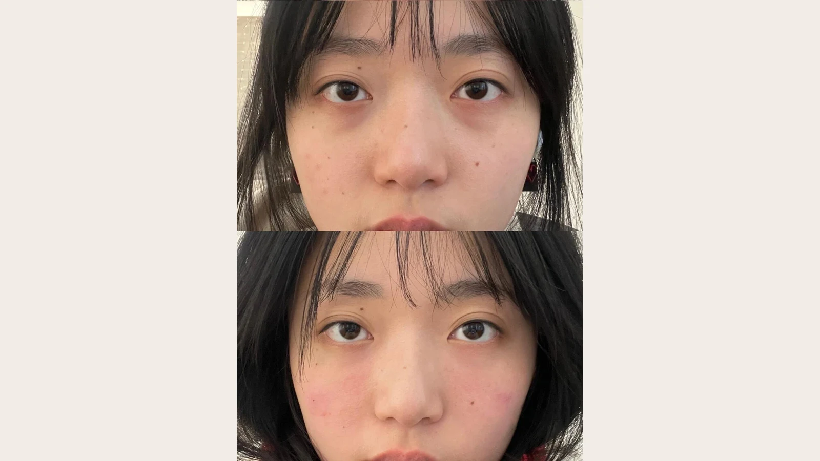 Peko 客人療程前後對比（真實個案，已獲同意）