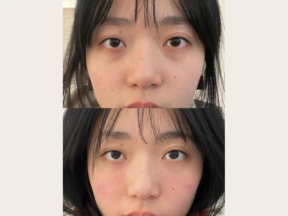 Peko 客人療程前後對比（同一客人、同一部位，已獲同意）