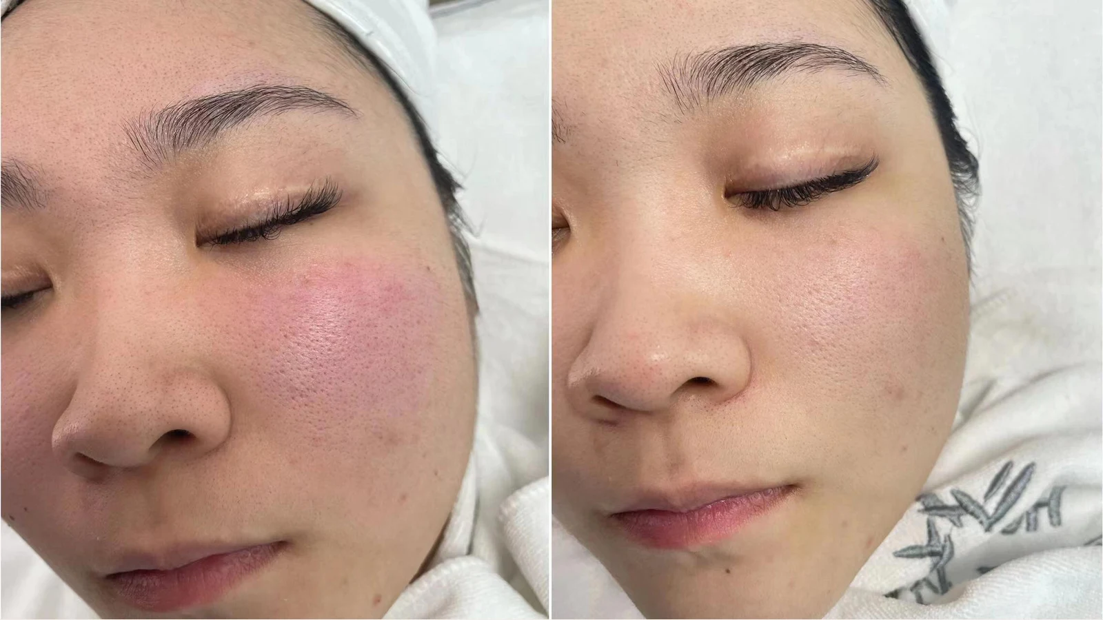 Peko 客人療程前後對比（真實個案，已獲同意）