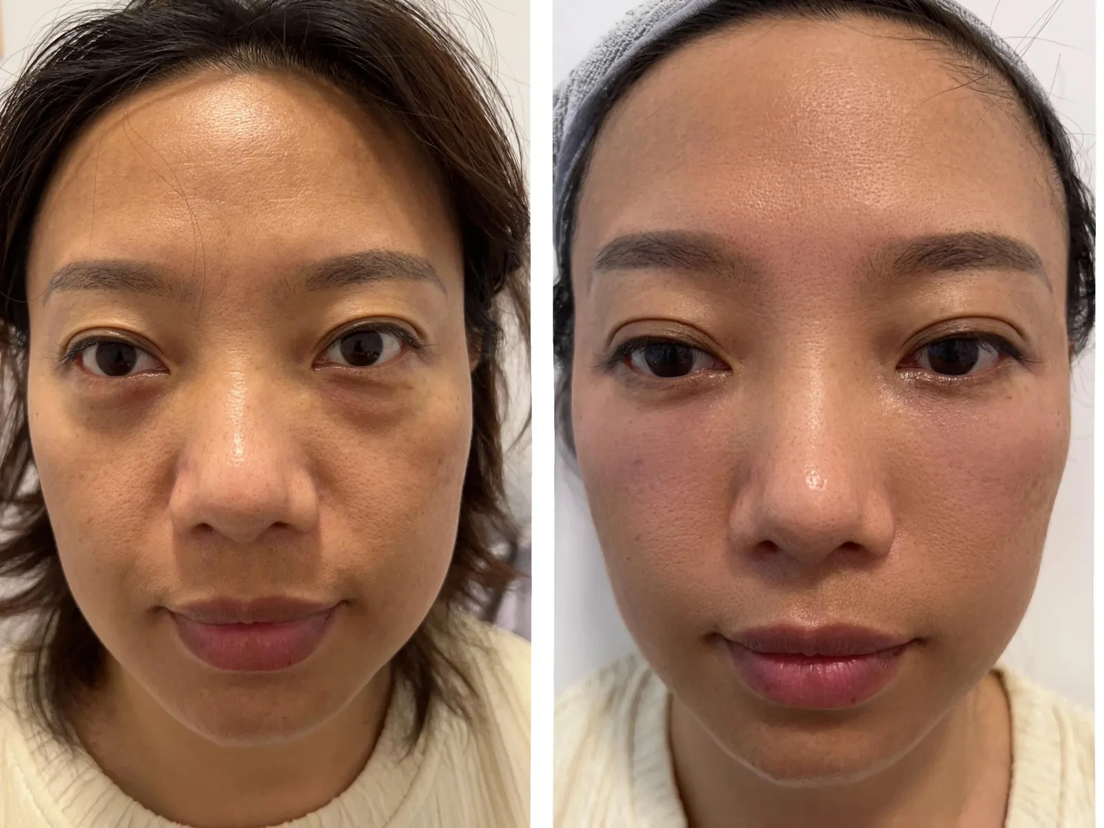 眼周浮腫及眼袋：客人提供的前後對照原相（左邊療程前、右邊療程後）